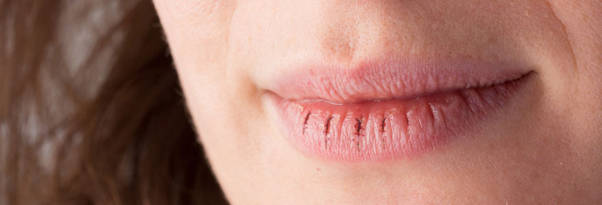 lèvres sèches